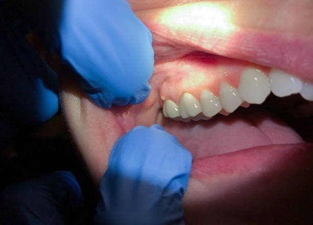 Best Dentist for Tooth Abscess  in Edina, MN